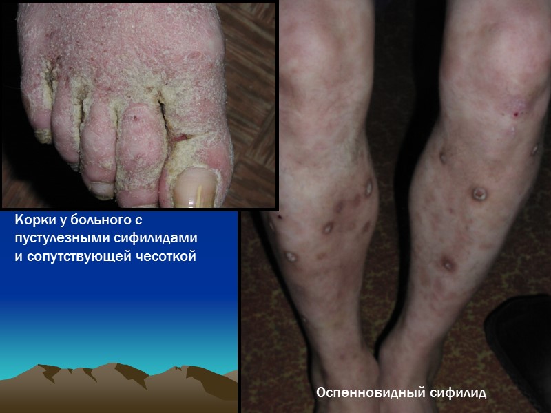 Оспенновидный сифилид Корки у больного с пустулезными сифилидами  и сопутствующей чесоткой